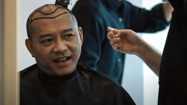 Agar Terbebas dari Kebotakan, Anang Hermansyah dan Atta Halilintar Kompak Transplantasi Rambut di Turki