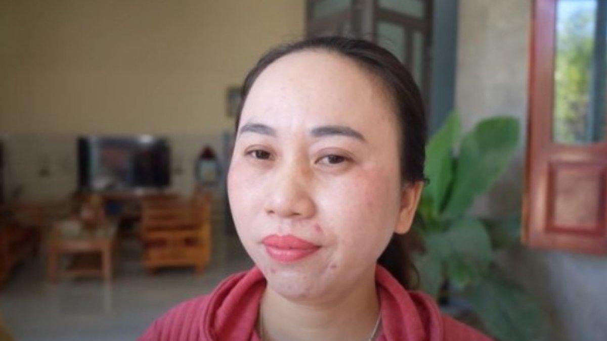 Kisah Wanita Vietnam yang Alami Insomnia Parah, 11 Tahun Tidak Tidur, Terpaksa Dibawa ke RSJ