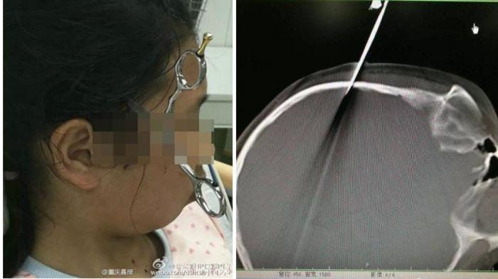 Sering nonton Adegan Kekerasan, Bocah Empat Tahun Lempar Gunting dan Menancap di Kepala Kakaknya