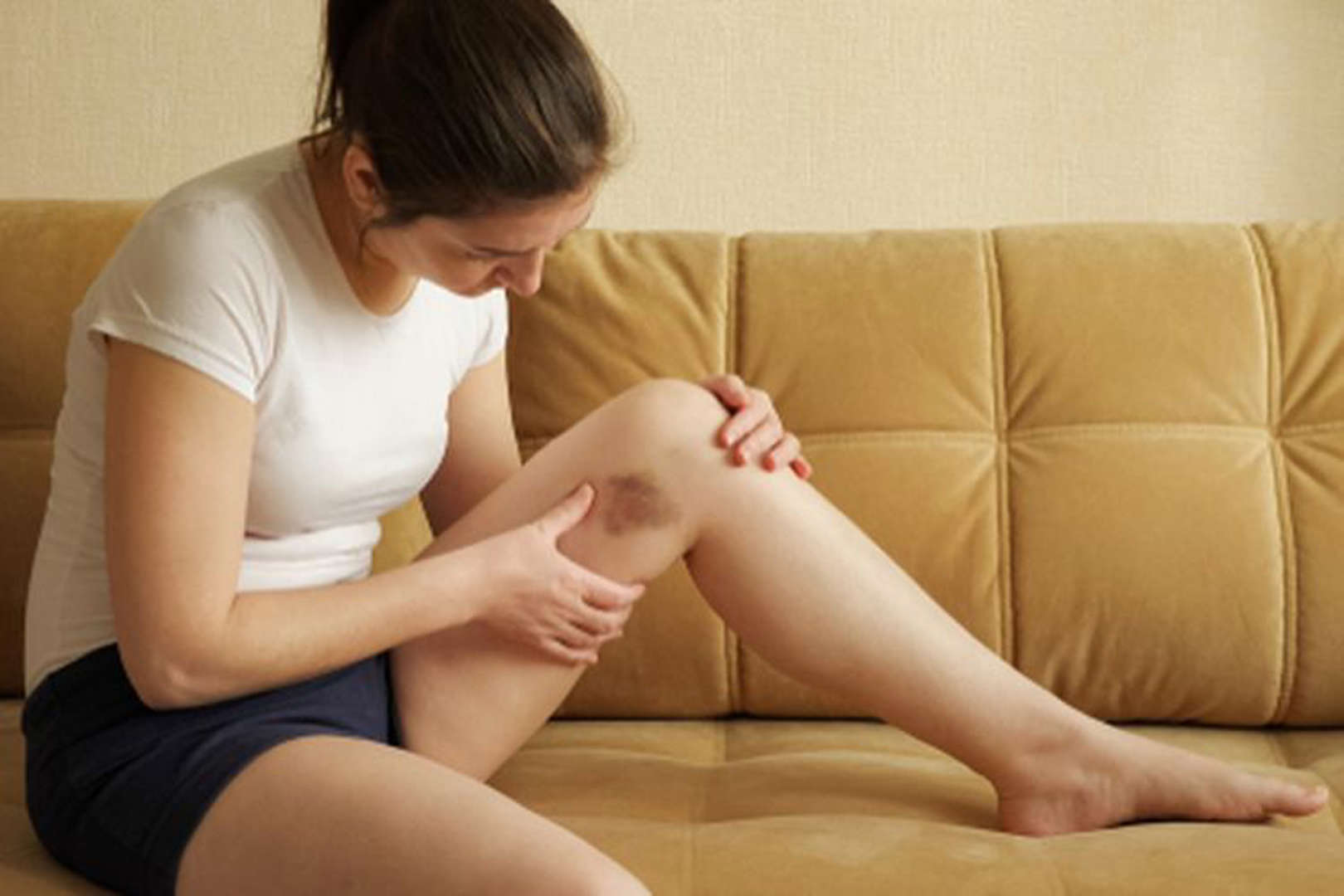 7 Penyebab Memar Tanpa Sebab di Muncul Tubuh, Termasuk Autoimun dan Kekurangan Vitamin K