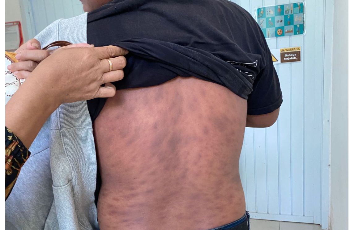 Prevalensi Kusta di Sulbar Masih Tinggi, Dinkes Perkuat Deteksi Dini dan Pengobatan